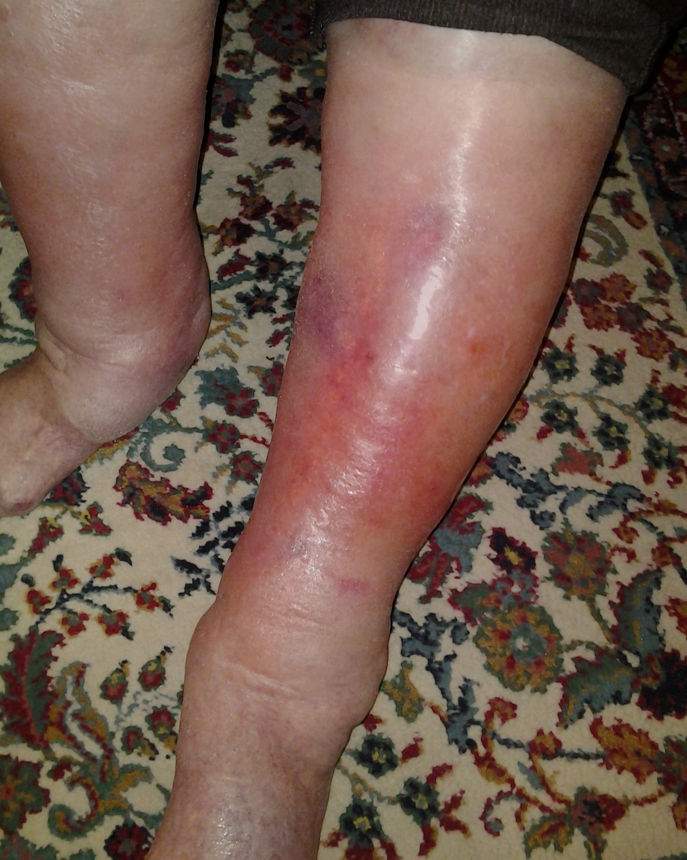 Erysipelas - Leg
