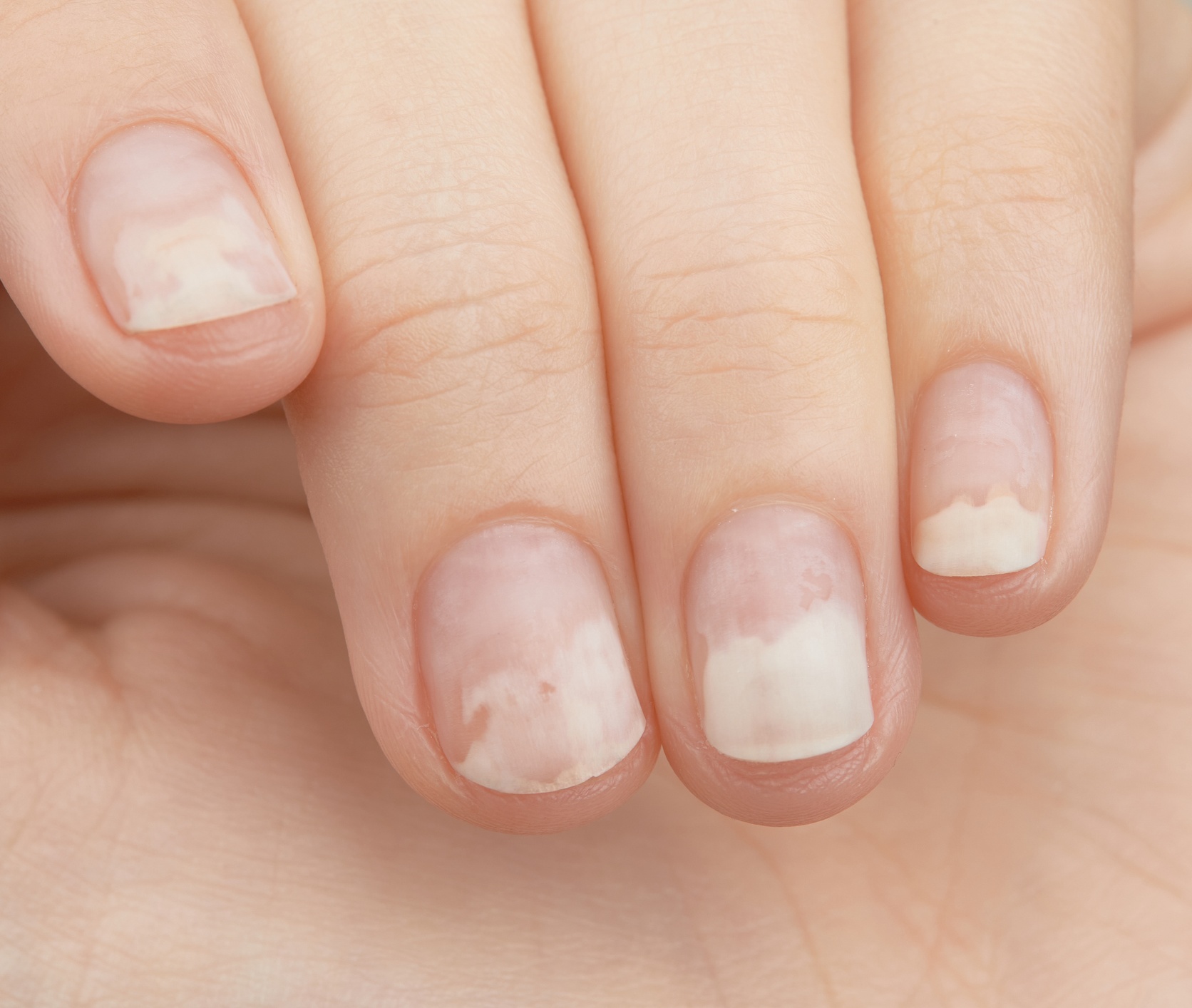 Onycholysis - Fingers