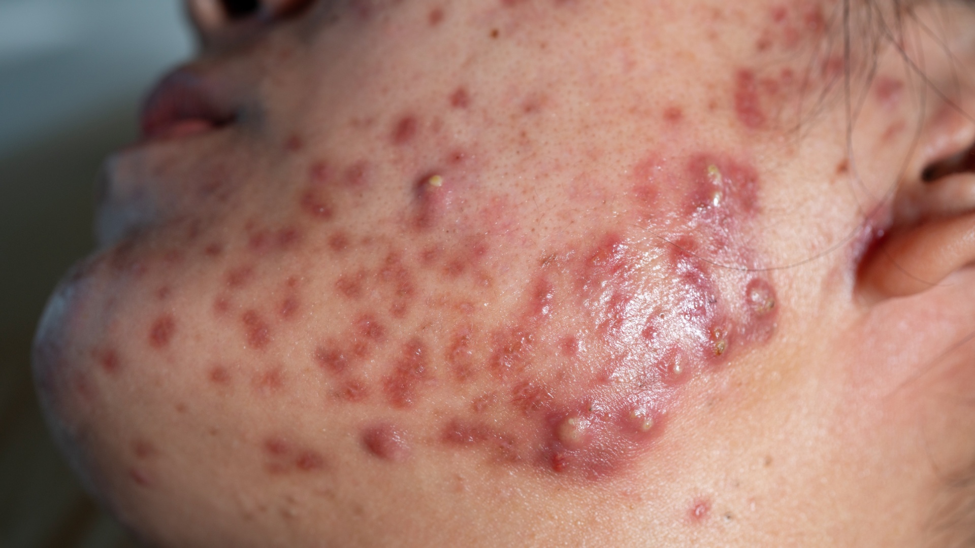 Acne Conglobata - Face