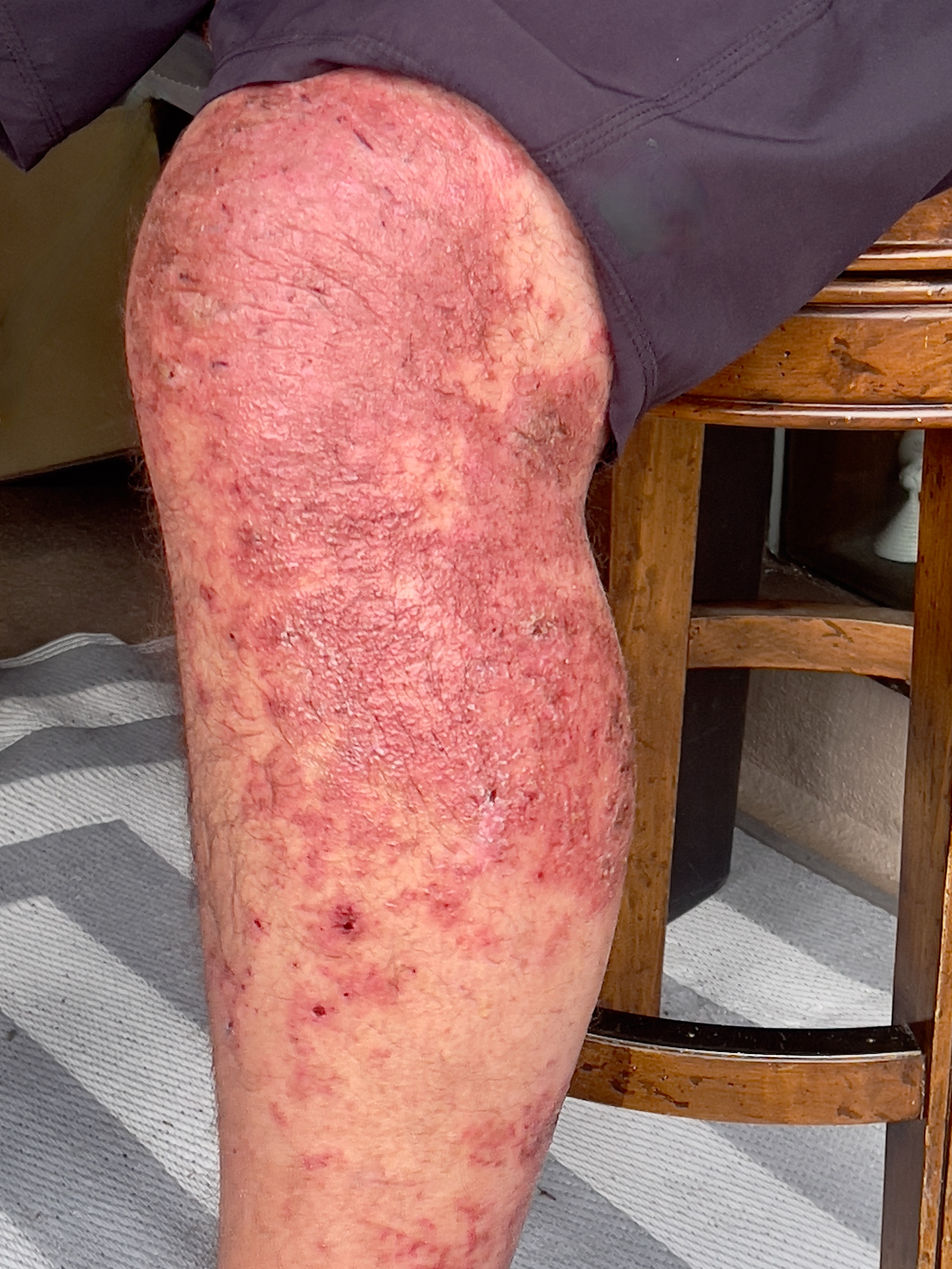 Atopic Dermatitis (Eczema) - Leg