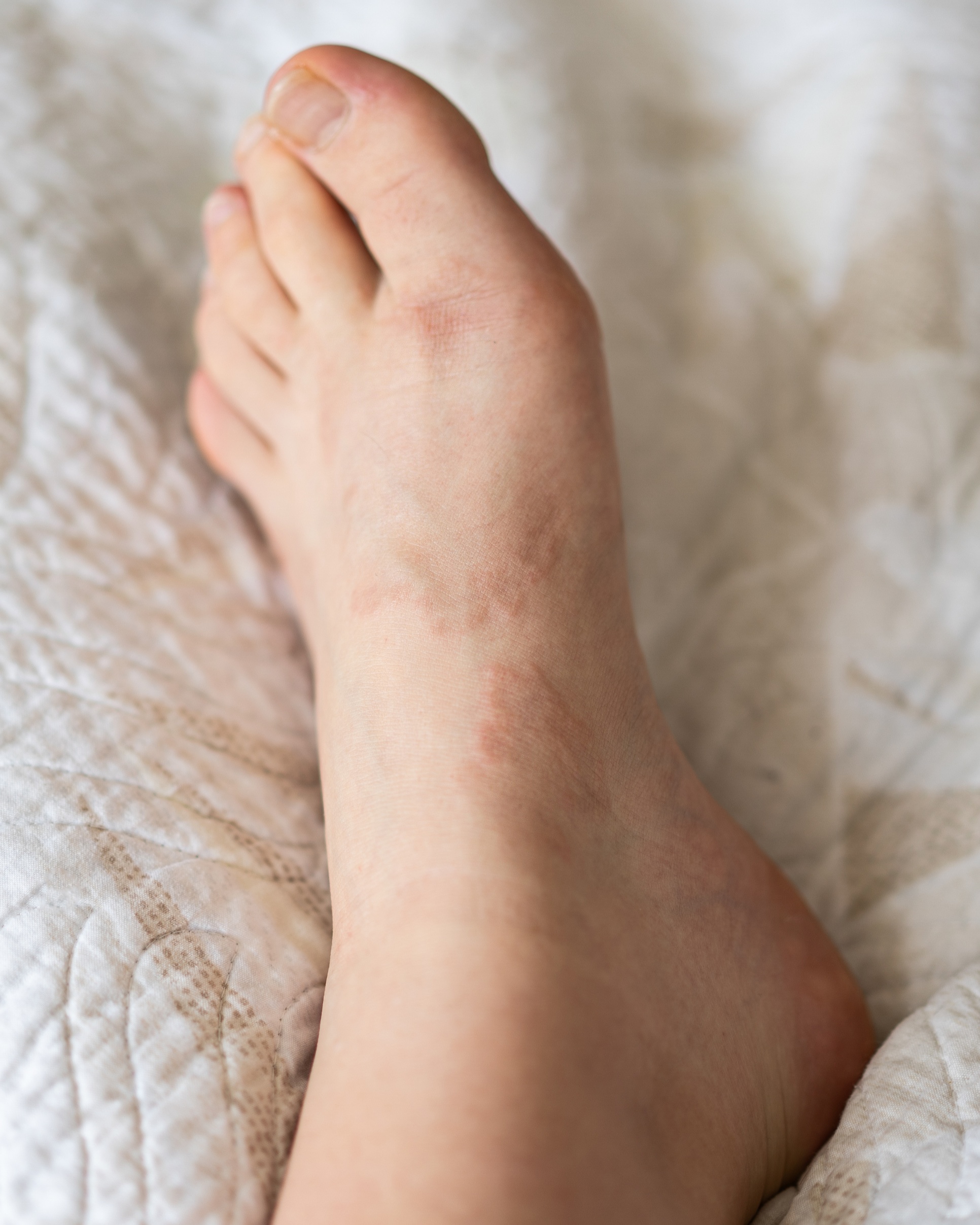 Granuloma Annulare - Foot
