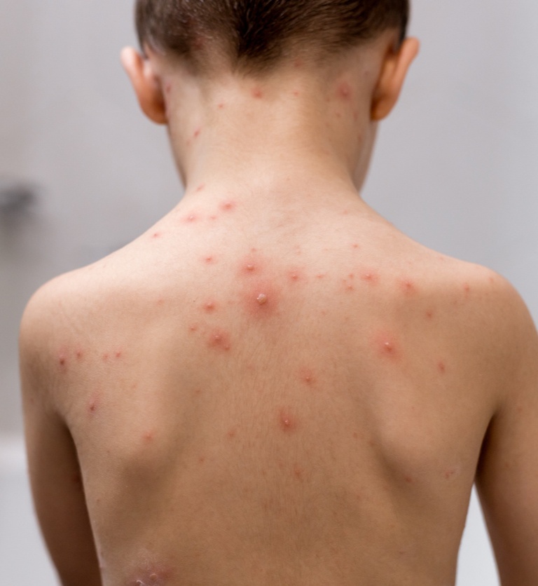 Varicella (Chickenpox) - Back