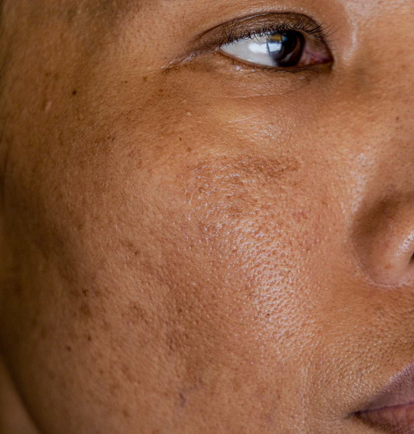 Melasma - Face