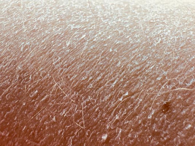 Xerosis Cutis (Dry Skin) - Not Specified