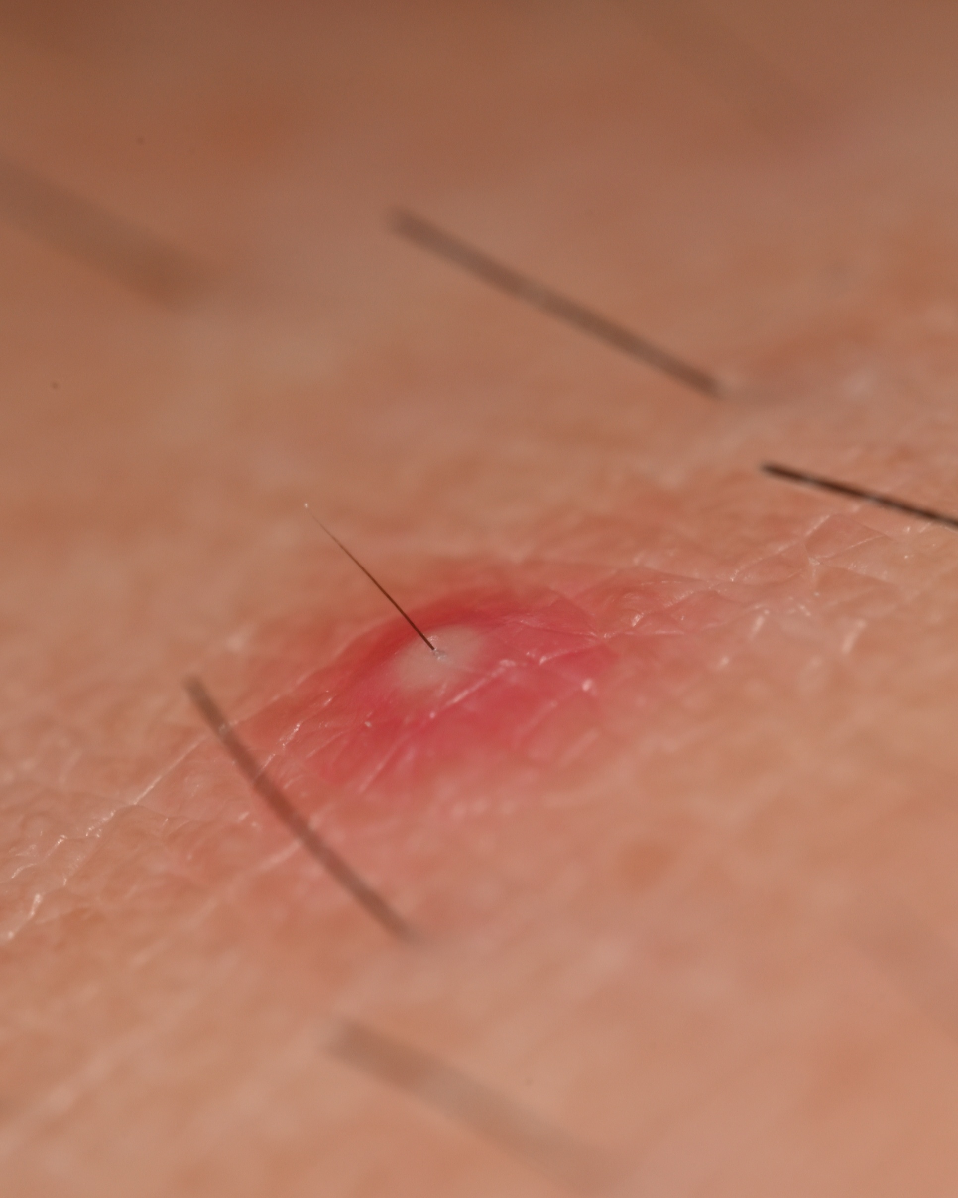 Folliculitis - Not Specified