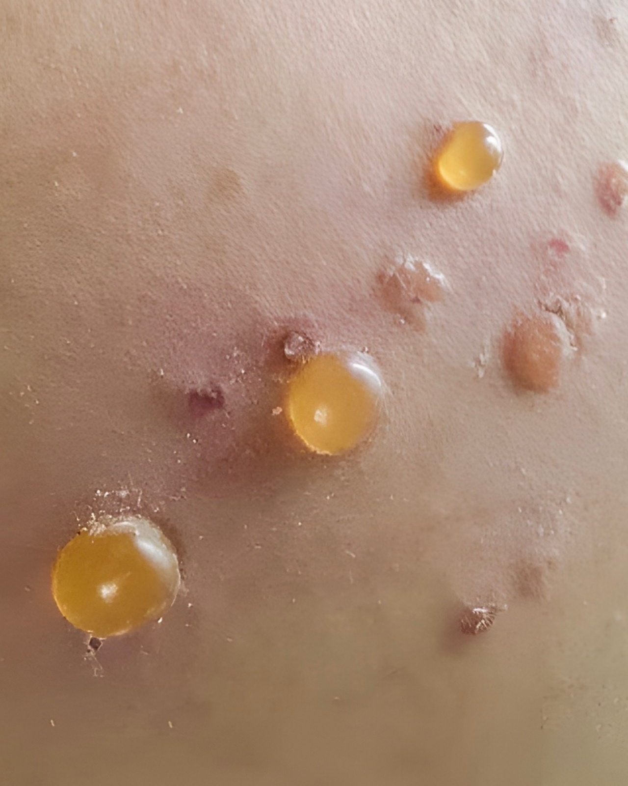 Bullous Pemphigoid - Back