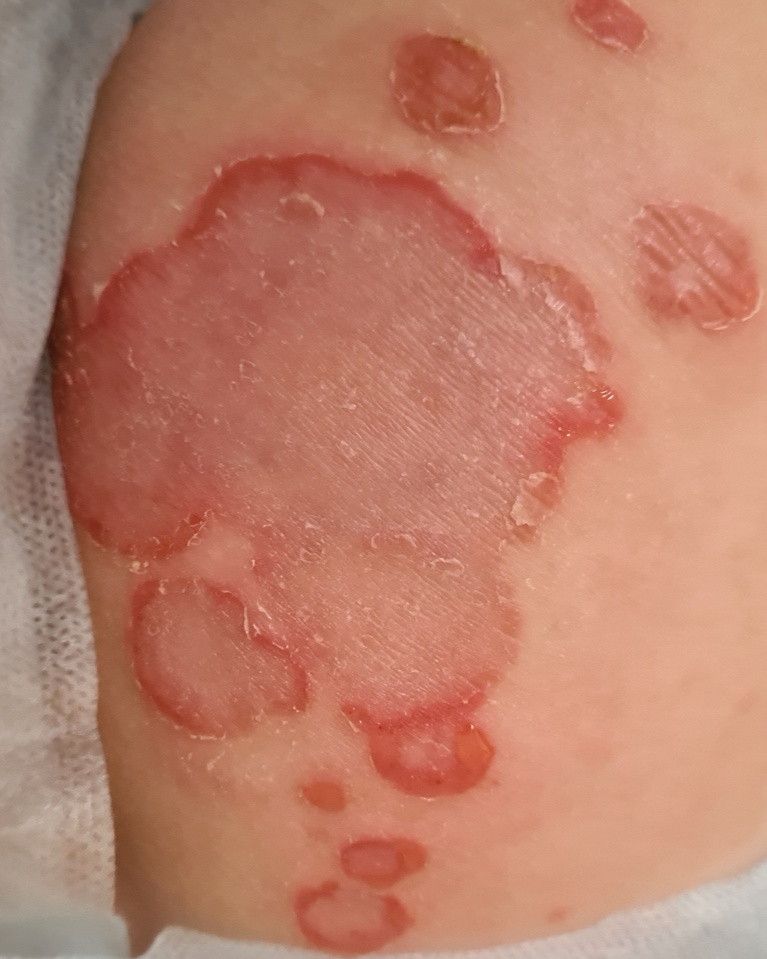 Pemphigus Vulgaris - Not Specified