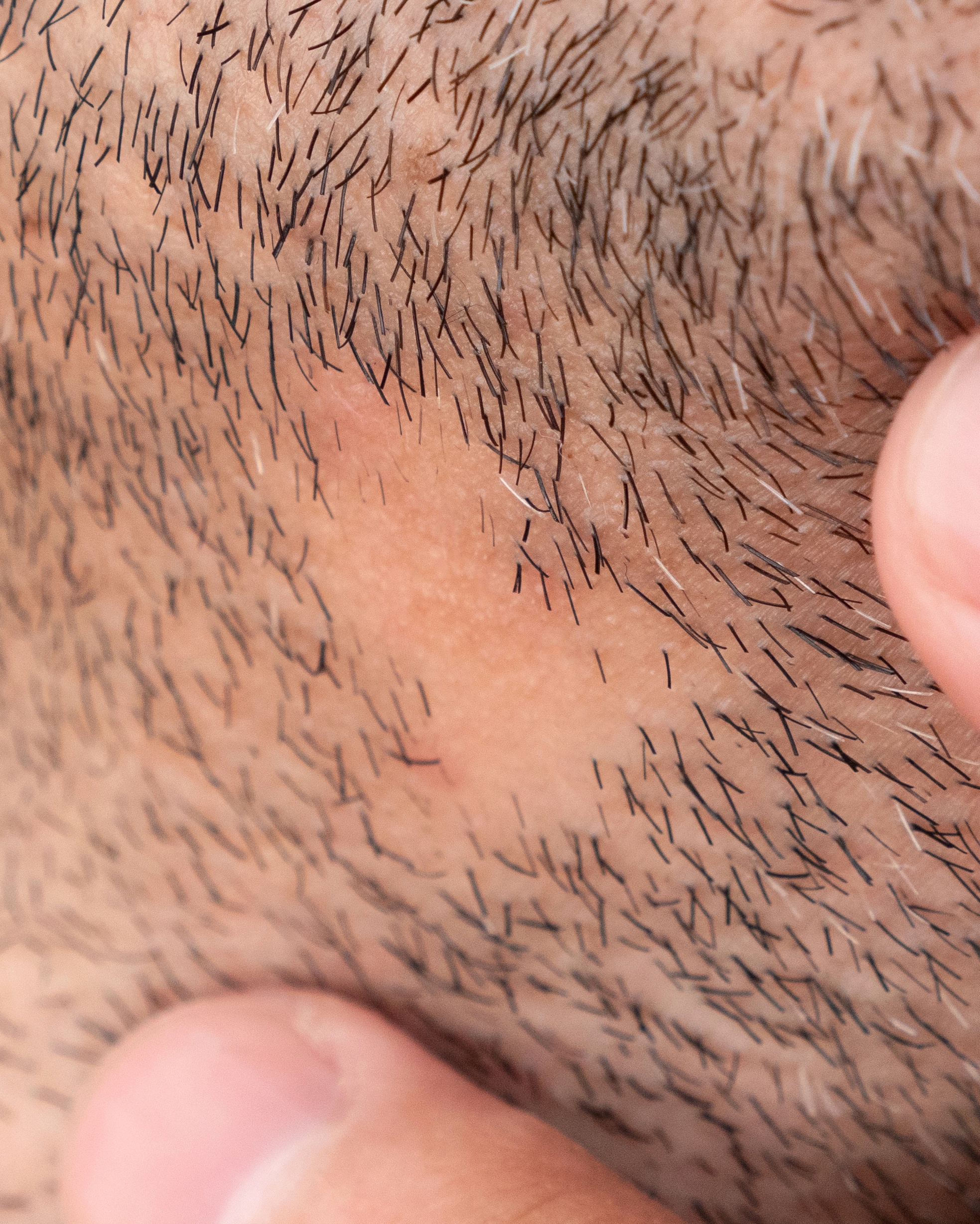 Cicatricial Alopecias - Face