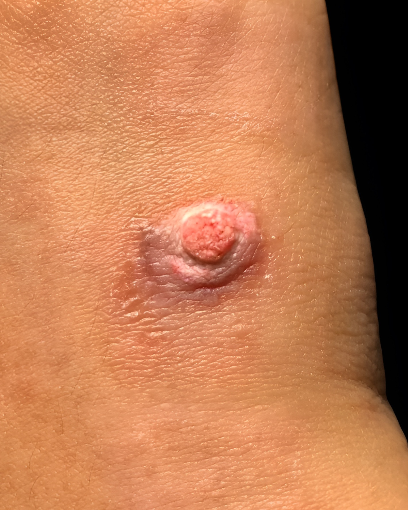 Pyogenic Granuloma Dermnet