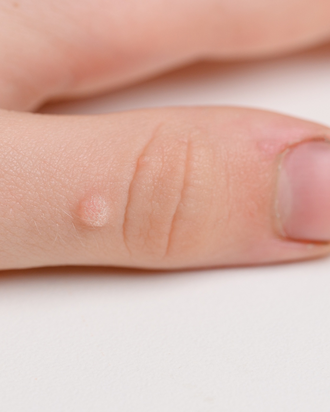 Verruca Vulgaris (Common Warts) - Thumb