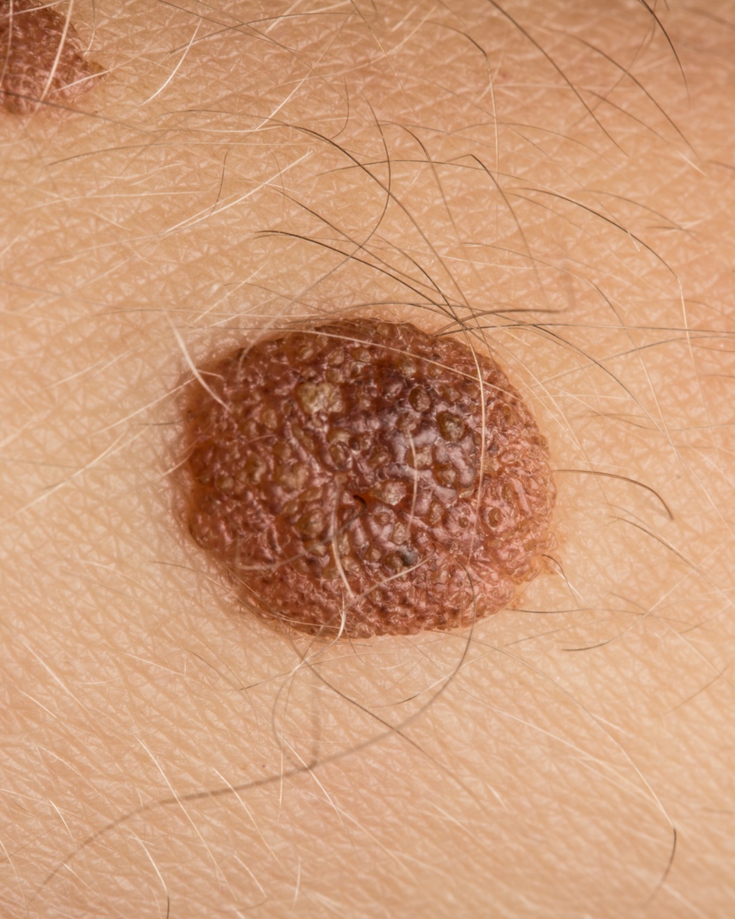 Seborrheic Keratosis - Not Specified