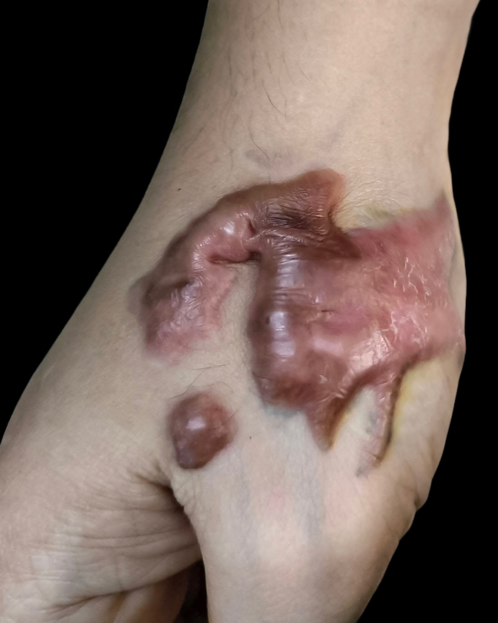 Keloid Scar - Hand
