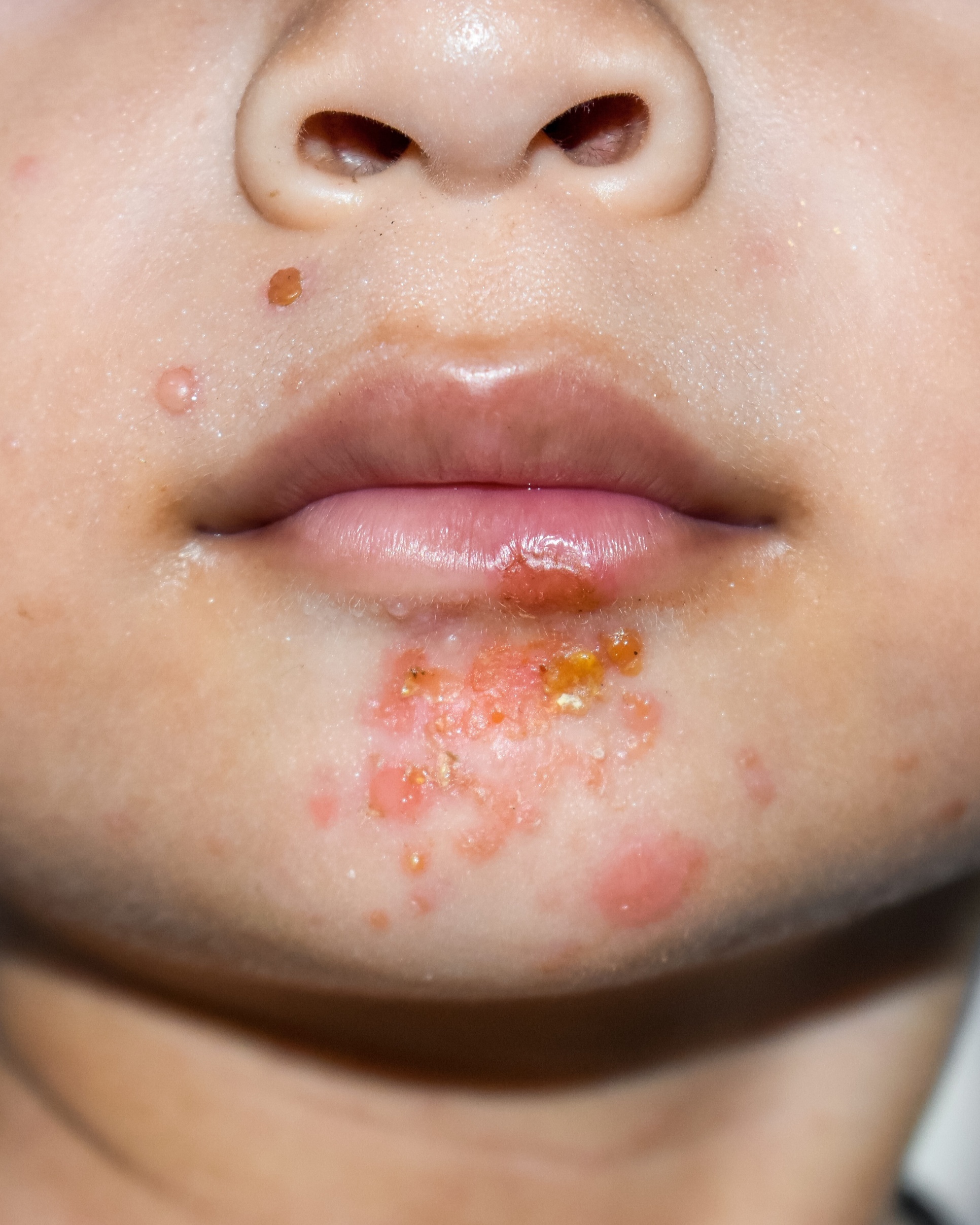 Impetigo - Face