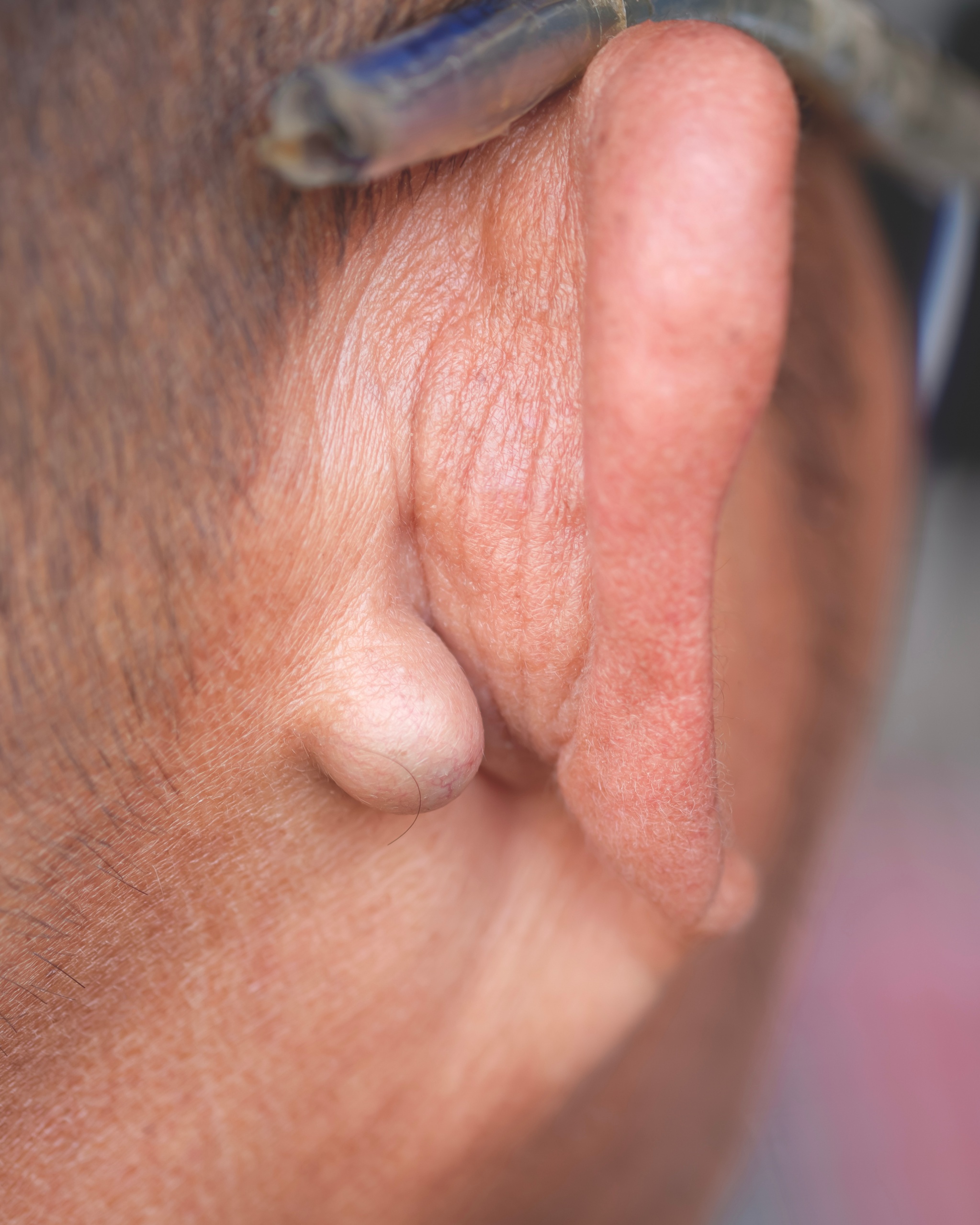 Epidermoid Cyst (Sebaceous Cyst) - Behind Ear