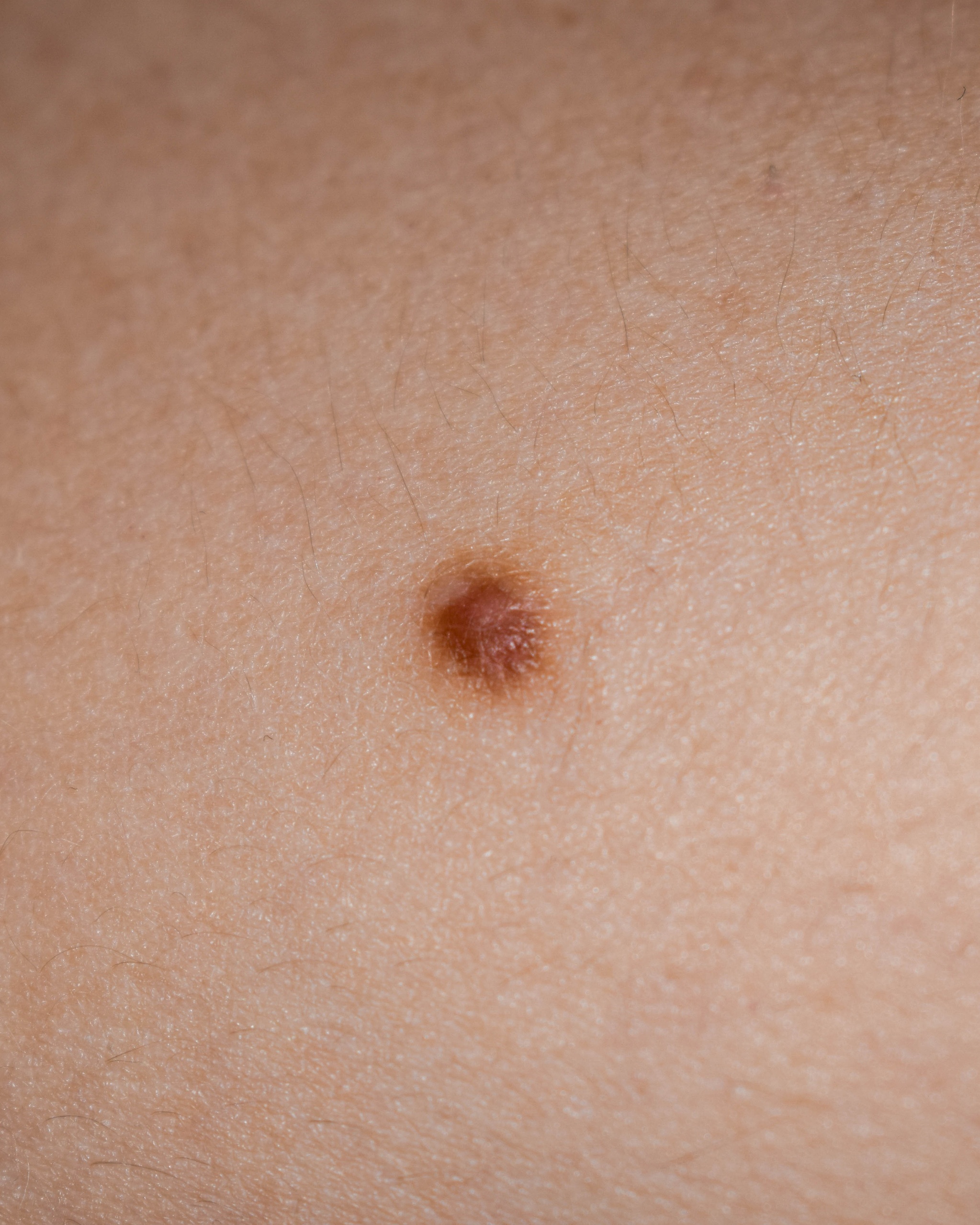 Dermatofibroma - Clinical image