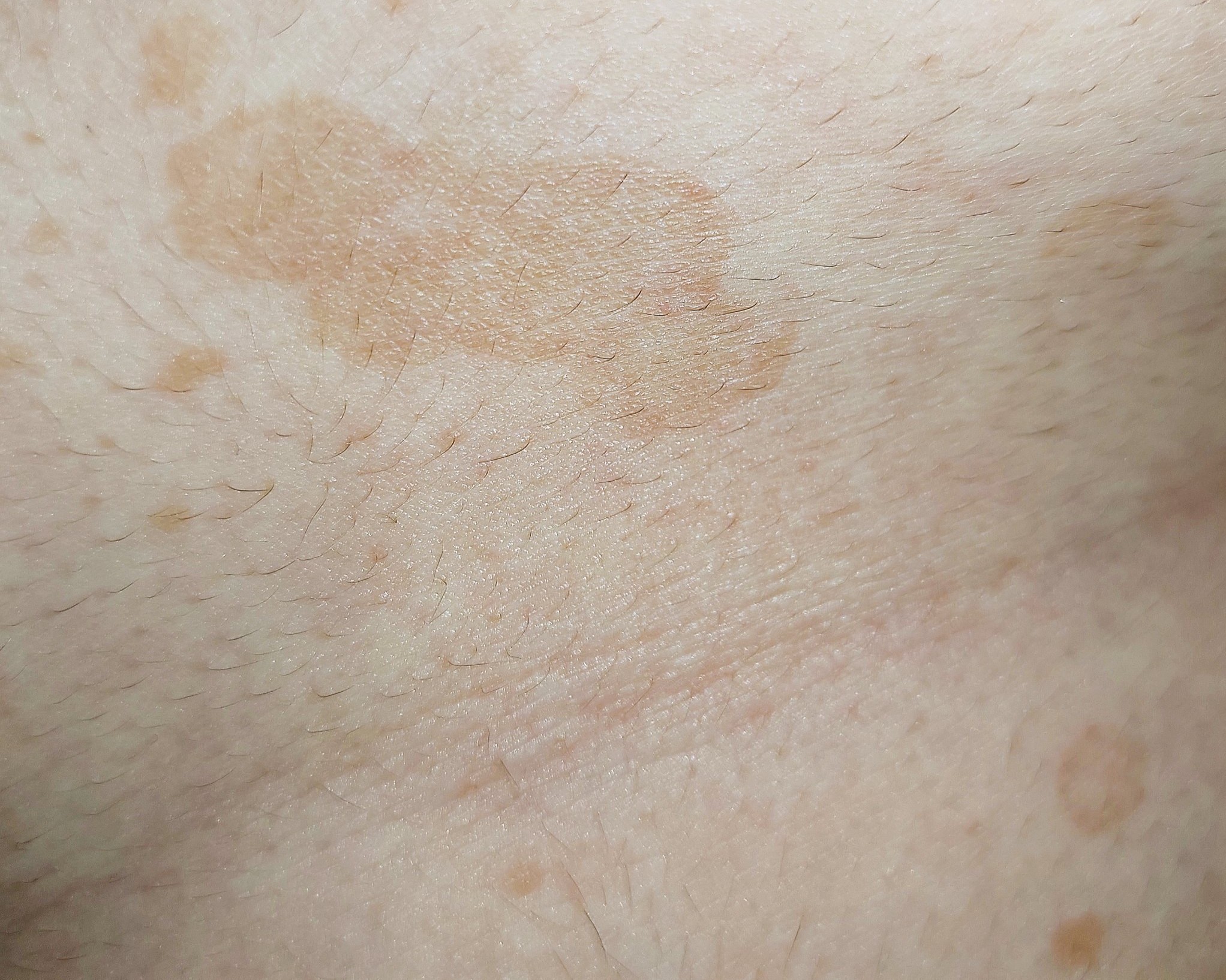 Tinea Versicolor (Pityriasis Versicolor) - Hip
