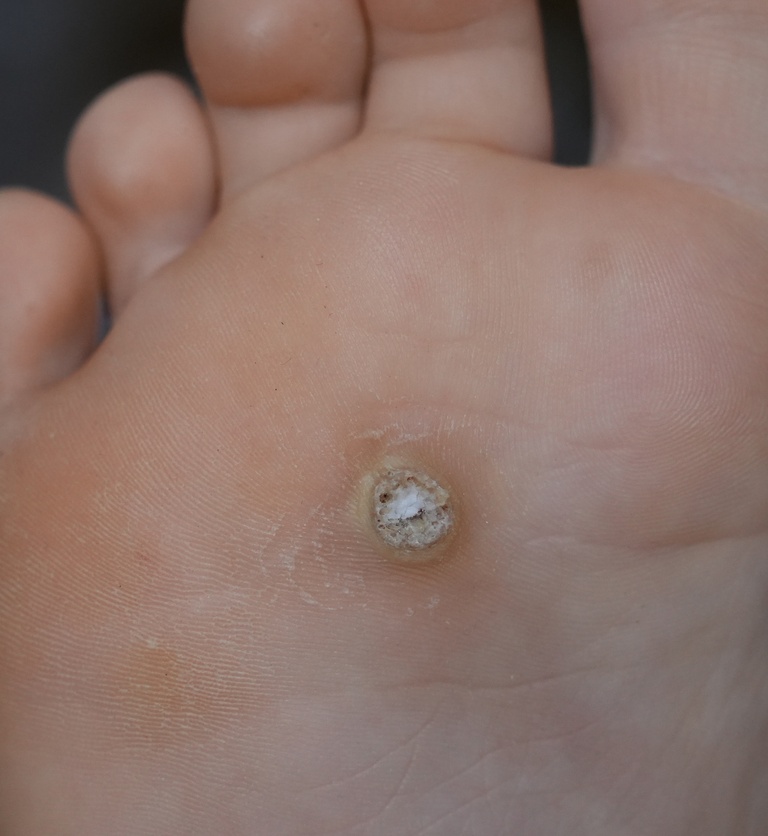Plantar Warts (Verruca Plantaris) - Foot