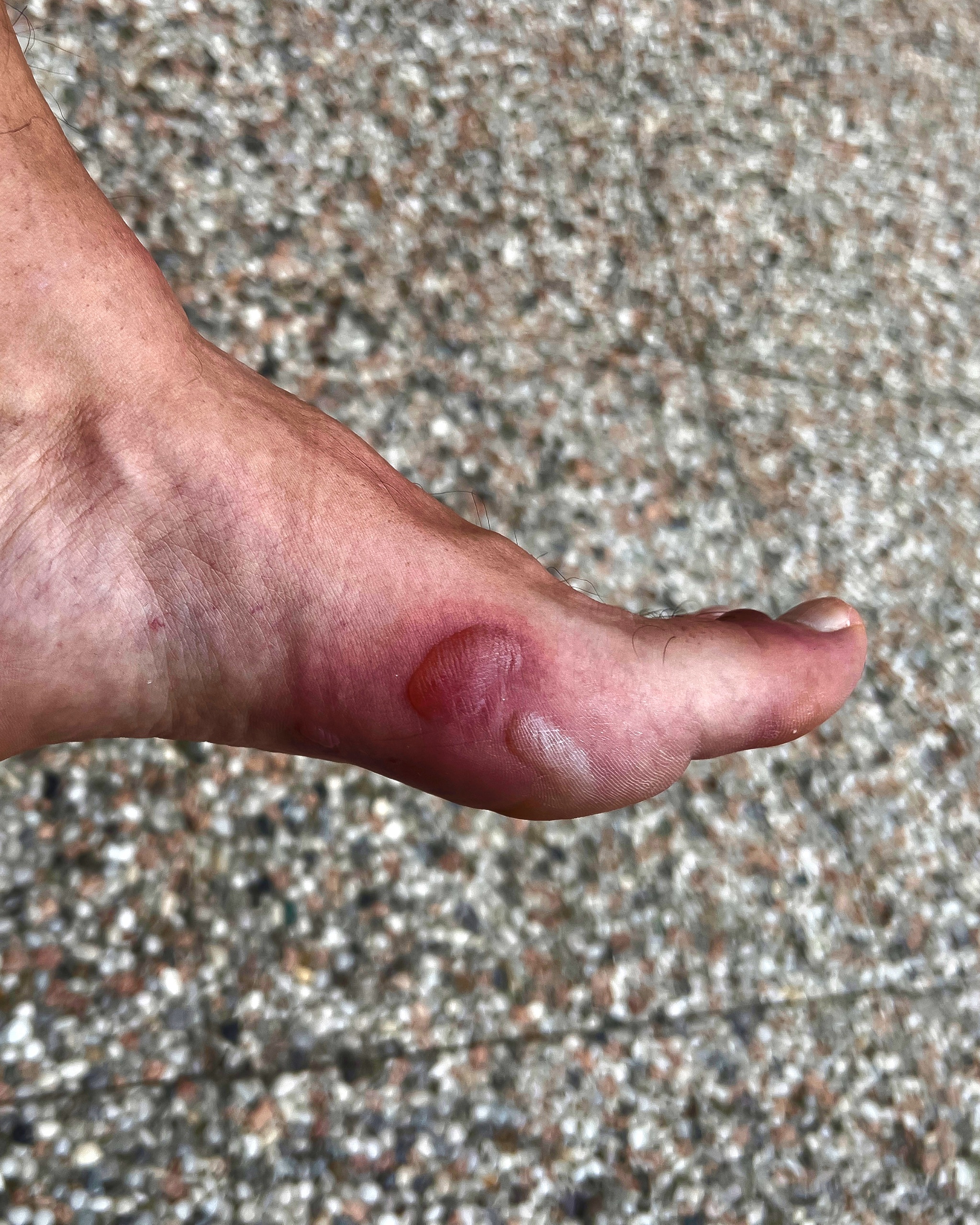 Friction Blister - Foot