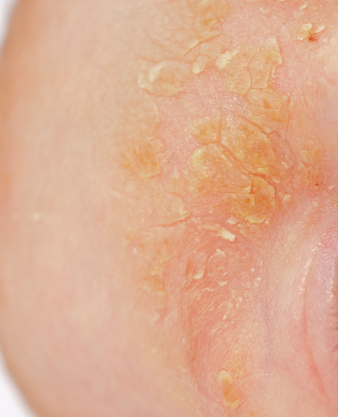 Seborrheic Dermatitis - Face