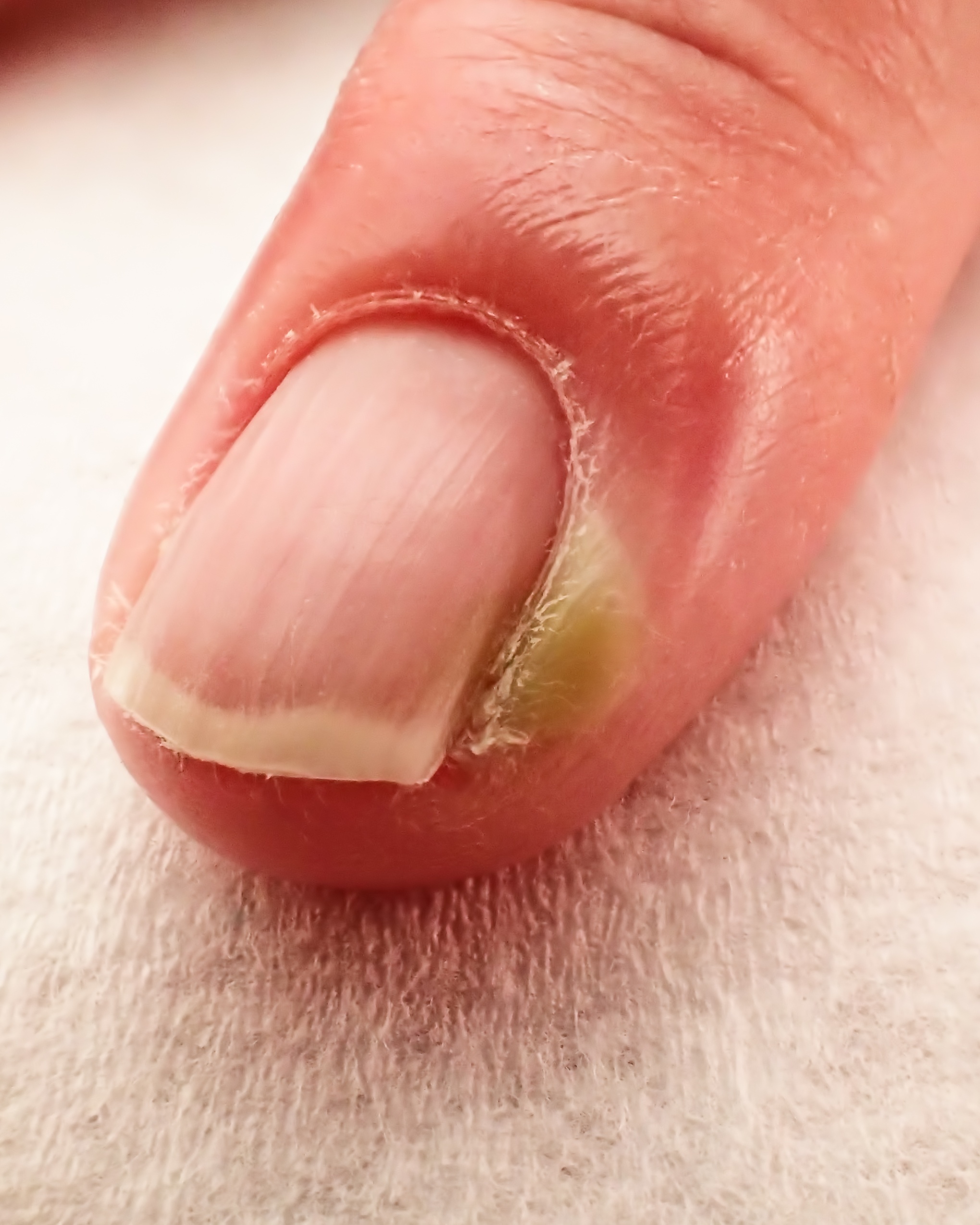 Paronychia (Acute/Chronic) - Finger