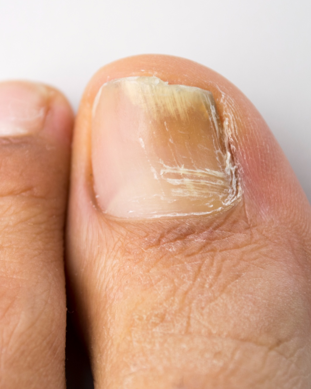 Onychomycosis (Fungal Nail Infection) - Toe