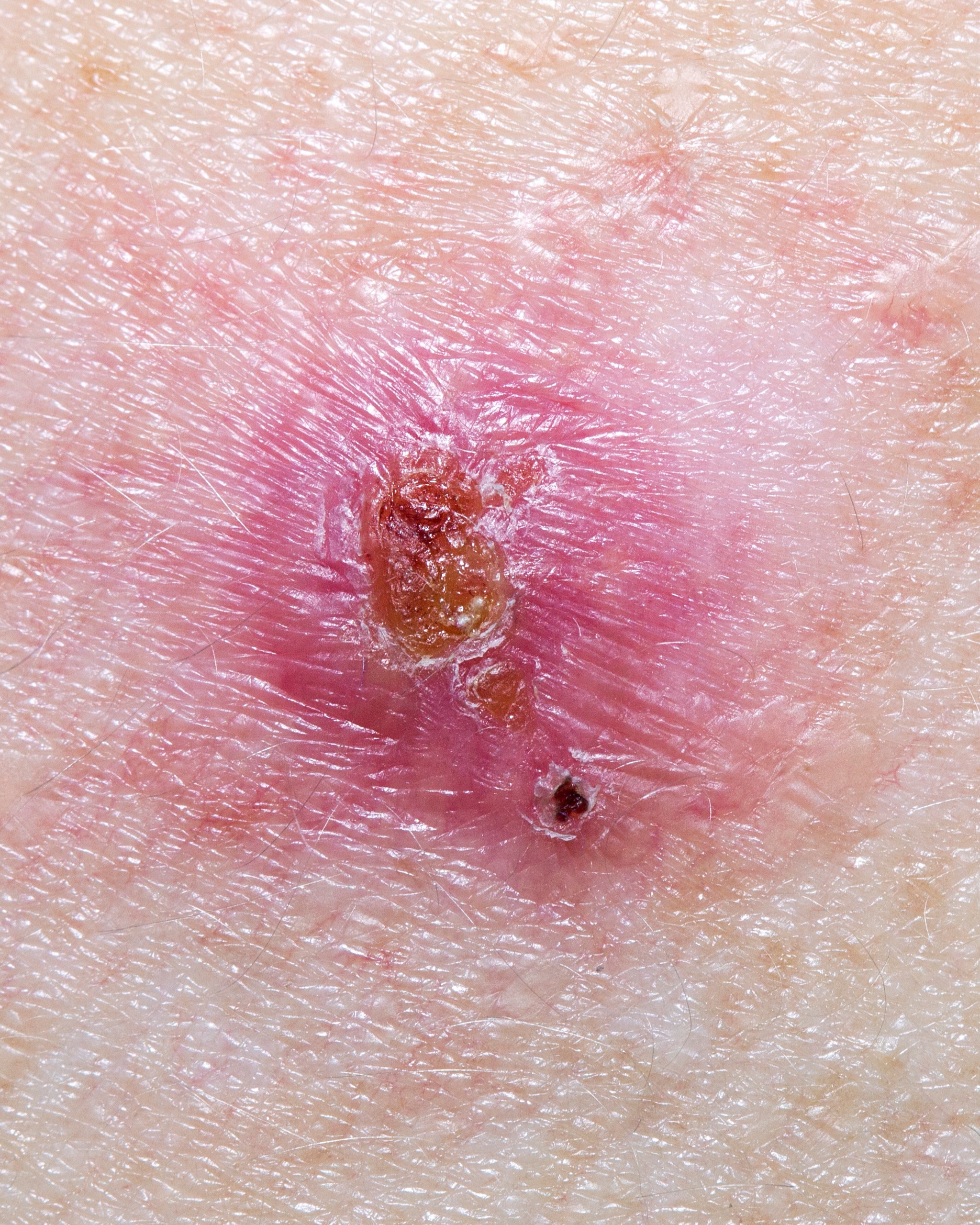 Basal Cell Carcinoma (BCC) - Clinical image