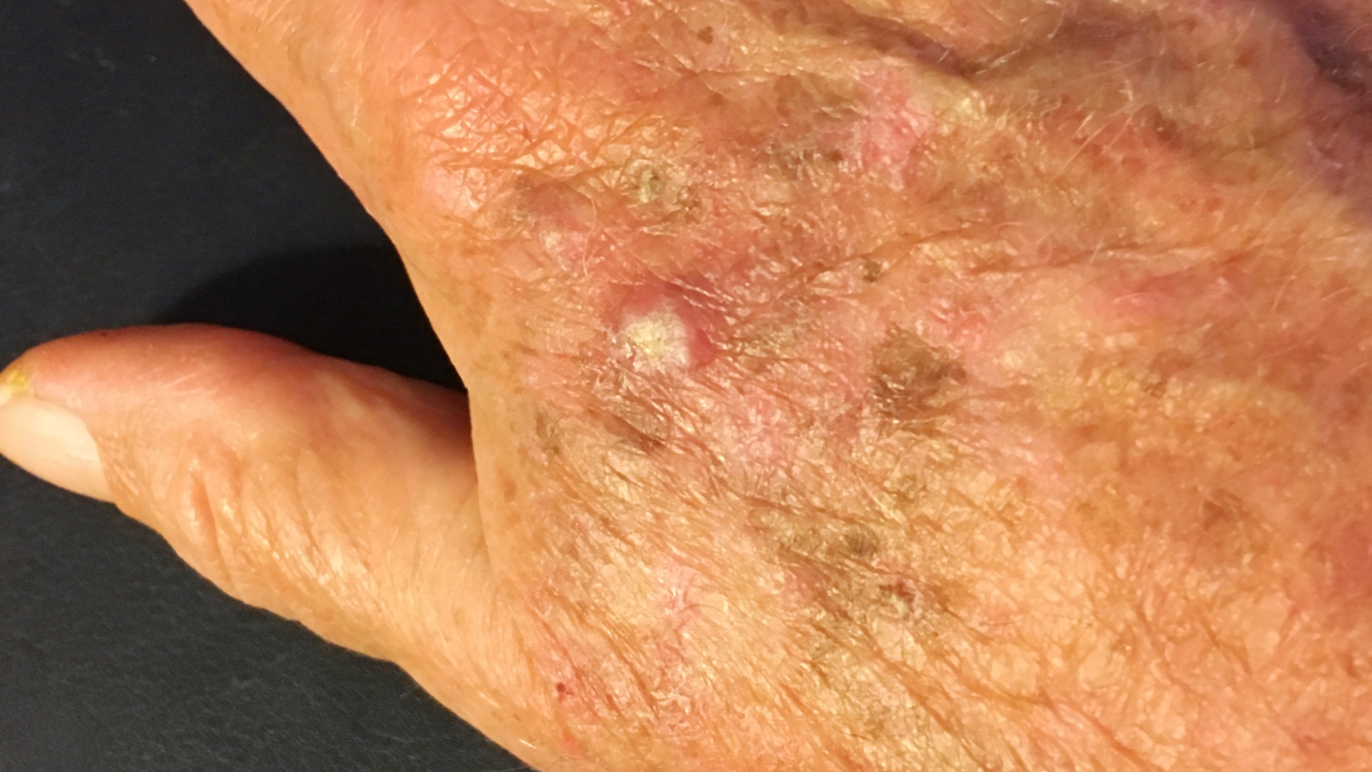 Actinic Keratosis - Hand