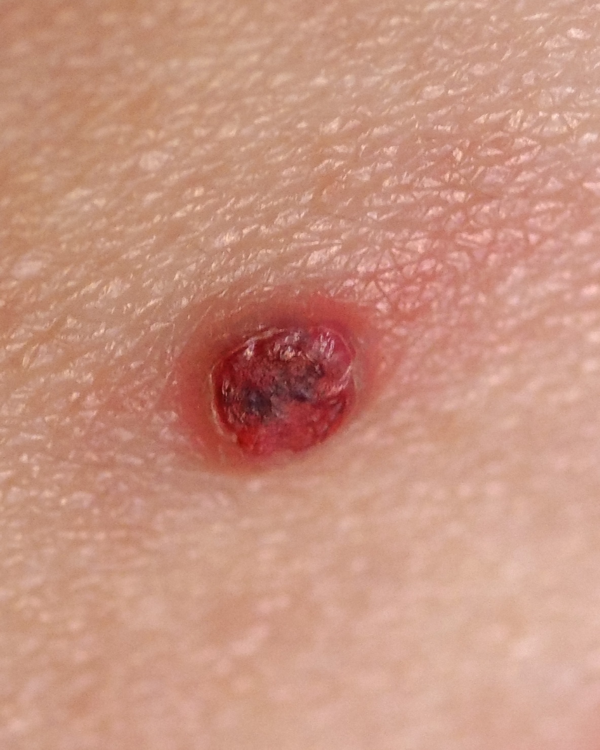 Pyogenic Granuloma - Not Specified