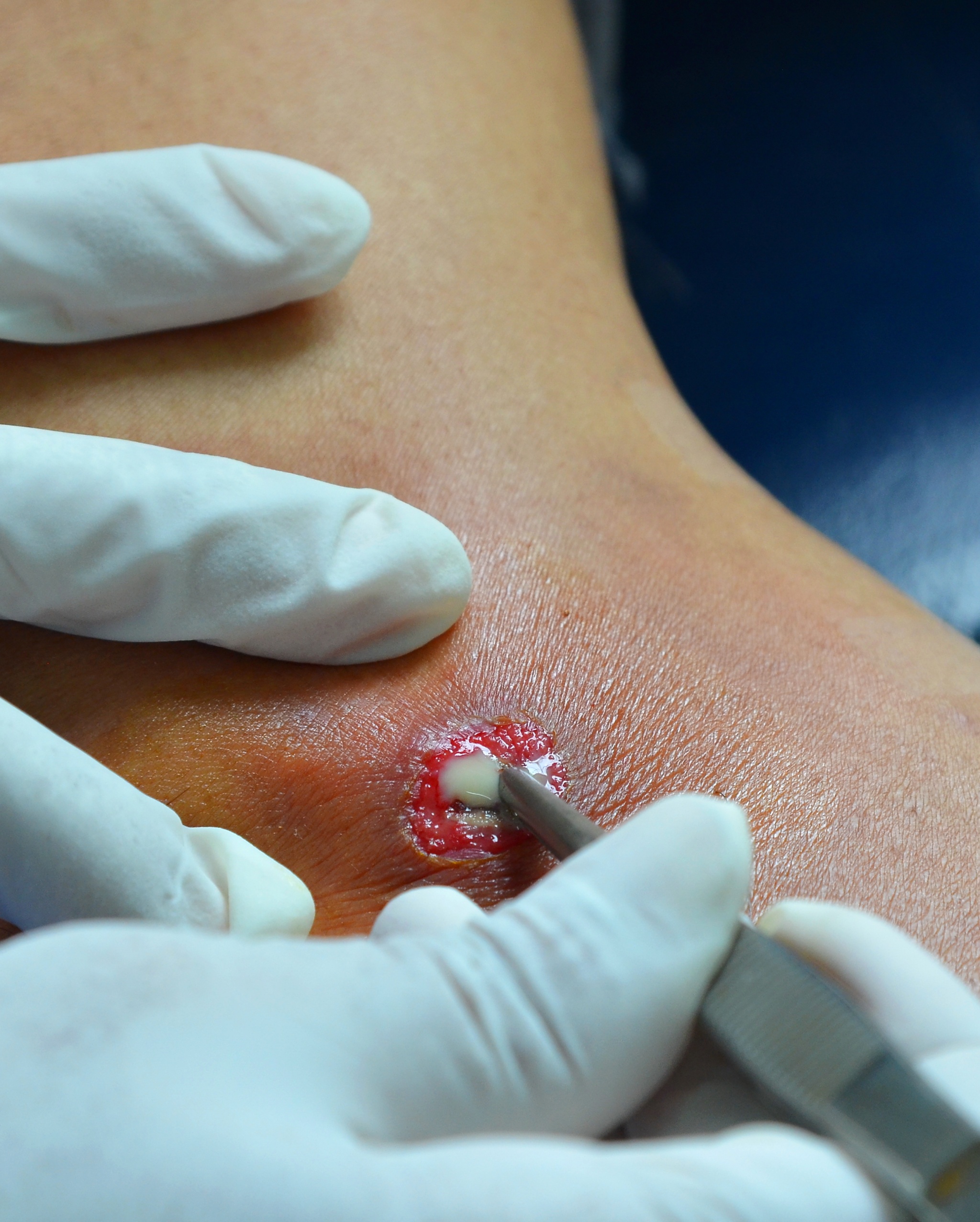 Cutaneous Abscess - Clinical image