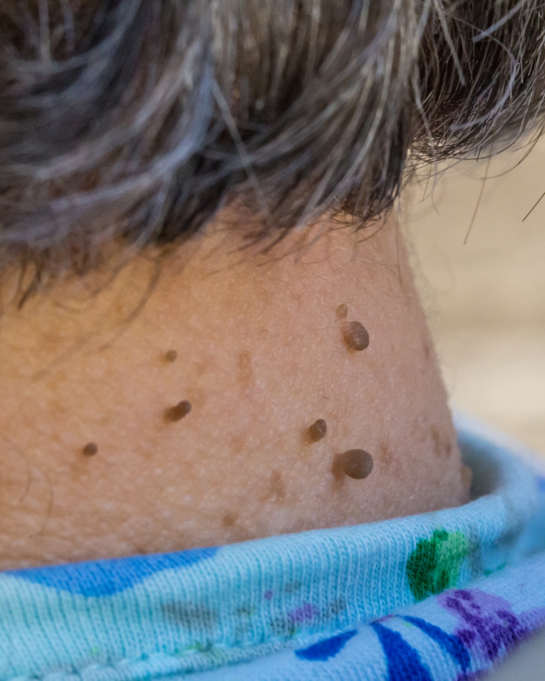 Skin Tag (Acrochordon) - Neck