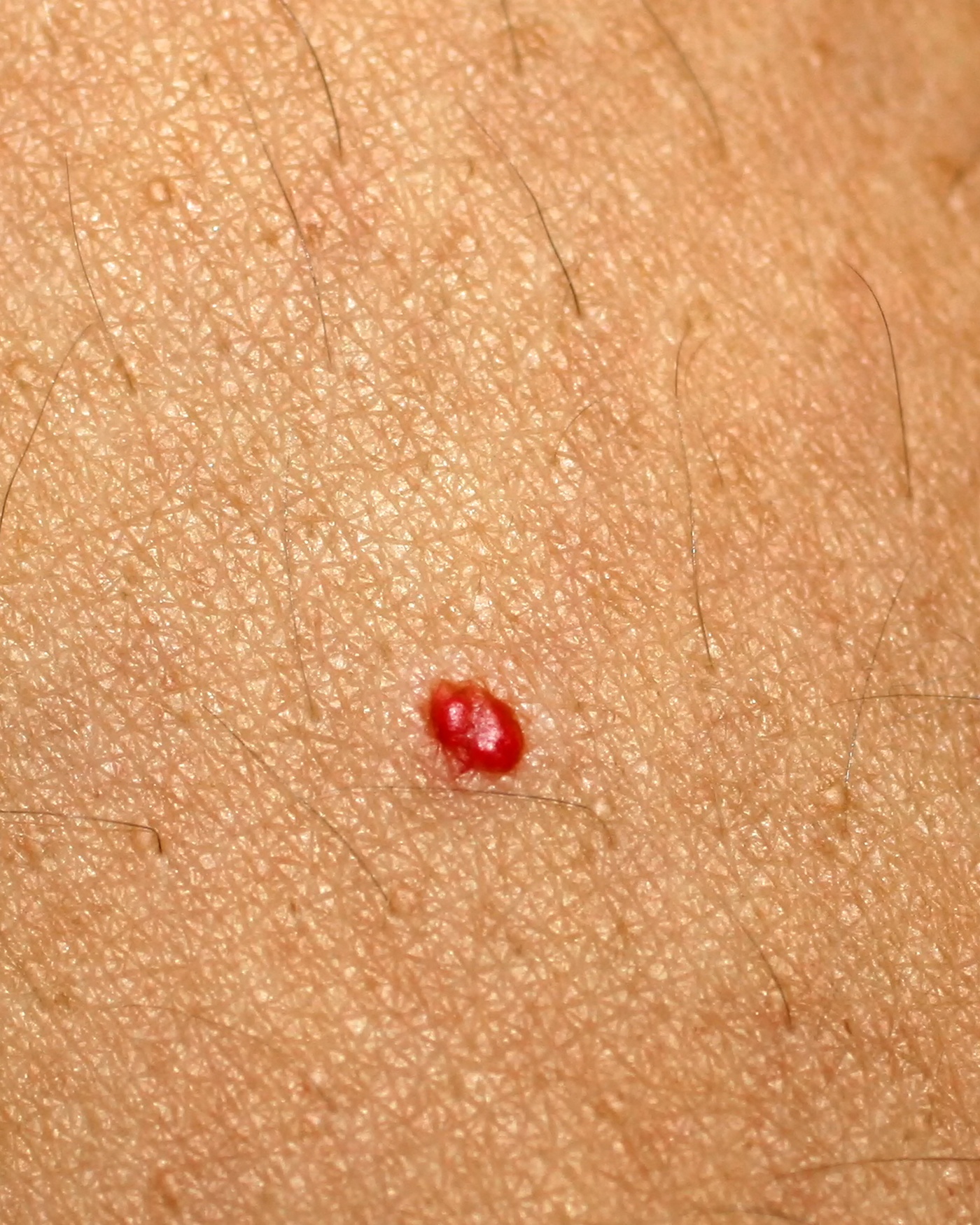 Cherry Angioma - Clinical image