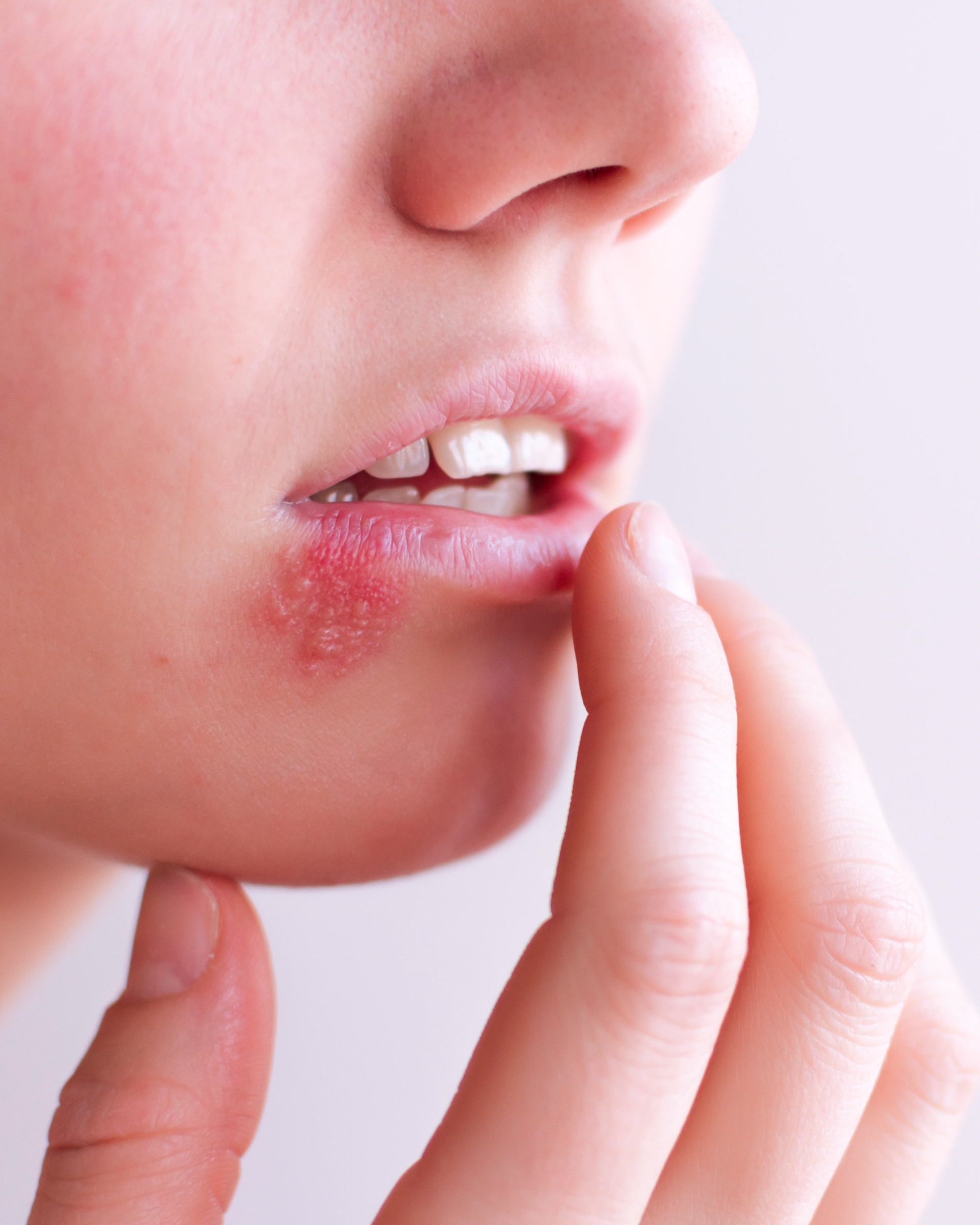 Herpes Simplex (Cold Sores / Genital Herpes) - Lips
