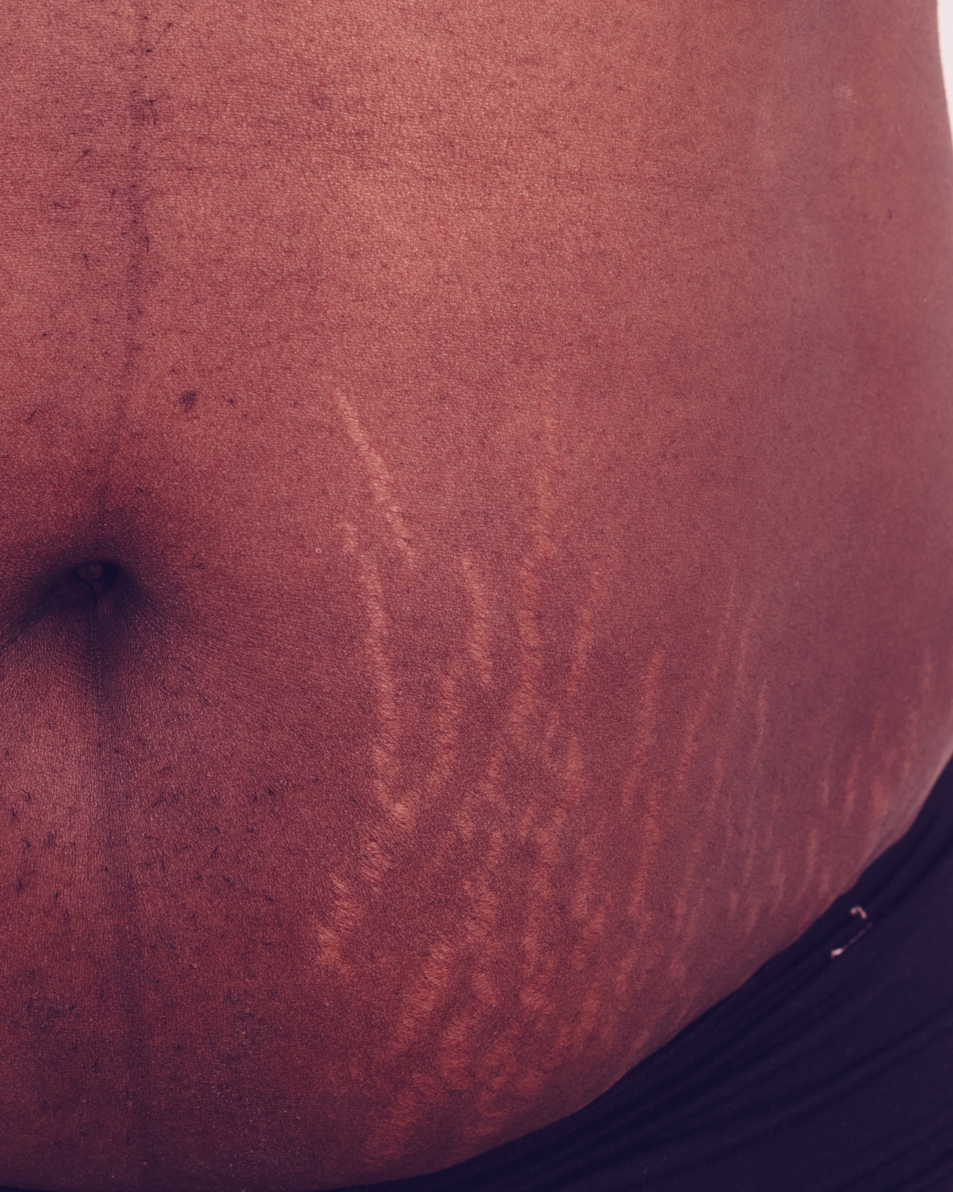 Striae Distensae (Stretch Marks) - Stomach