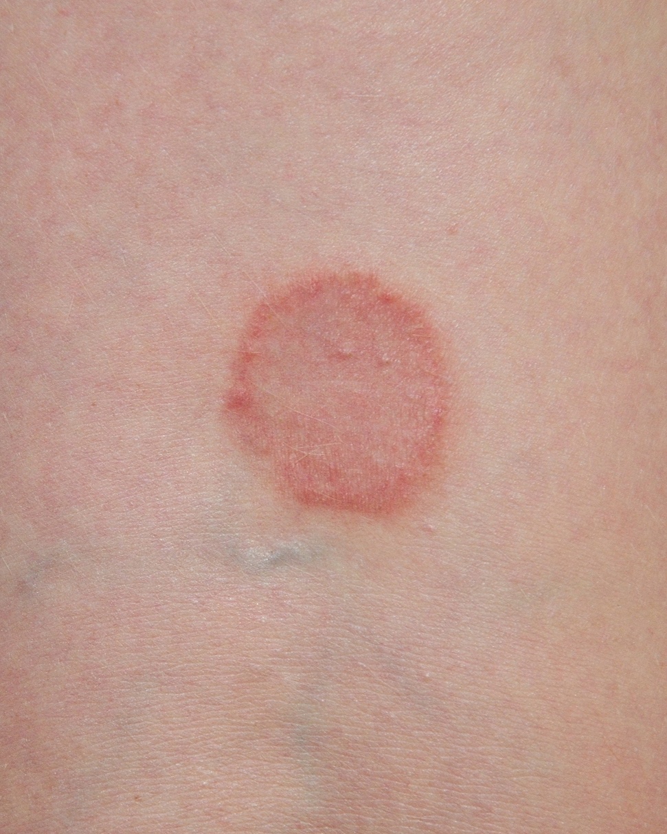 Tinea Corporis (Ringworm) - Arm
